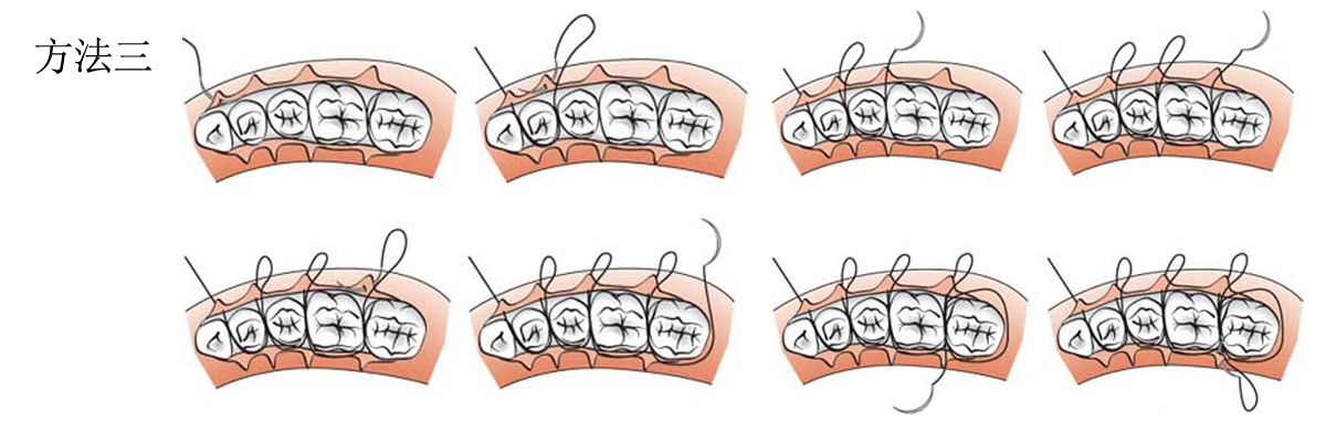醫(yī)用手術縫合線縫合方法.jpg